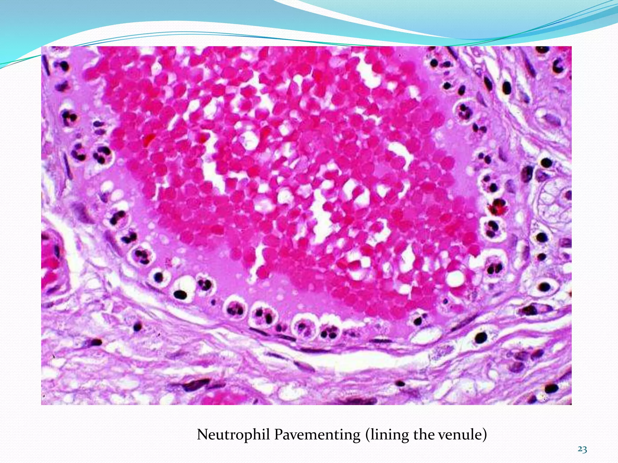 Neutrophil Pavementing (lining the venule)
23
 