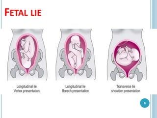 FETAL LIE
6
 