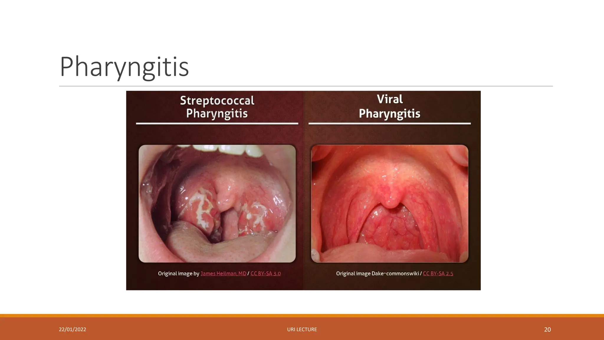 Pharyngitis
22/01/2022 URI LECTURE 20
 