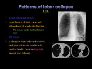 Triangular Sign Chest Lecture 7 | PPT