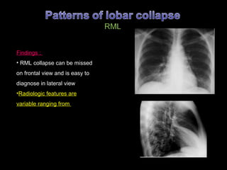 Rml Collapse Radiograph Lecture 7 | PPT