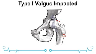 Type I Valgus Impacted