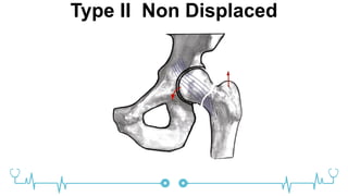 Type II Non Displaced