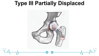 Type III Partially Displaced