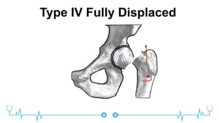Type IV Fully Displaced