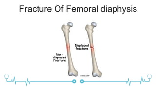 Fracture Of Femoral diaphysis