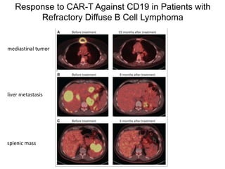 Response to CAR-T Against CD19 in Patients with
Refractory Diffuse B Cell Lymphoma
mediastinal tumor
liver metastasis
splenic mass
 