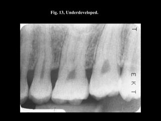 Fig. 13, Underdeveloped.
 