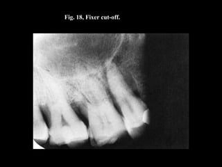 Fig. 18, Fixer cut-off.
 