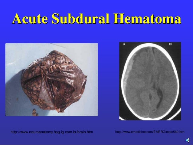 subdural hematoma blown pupil subdural hematoma blown pupil