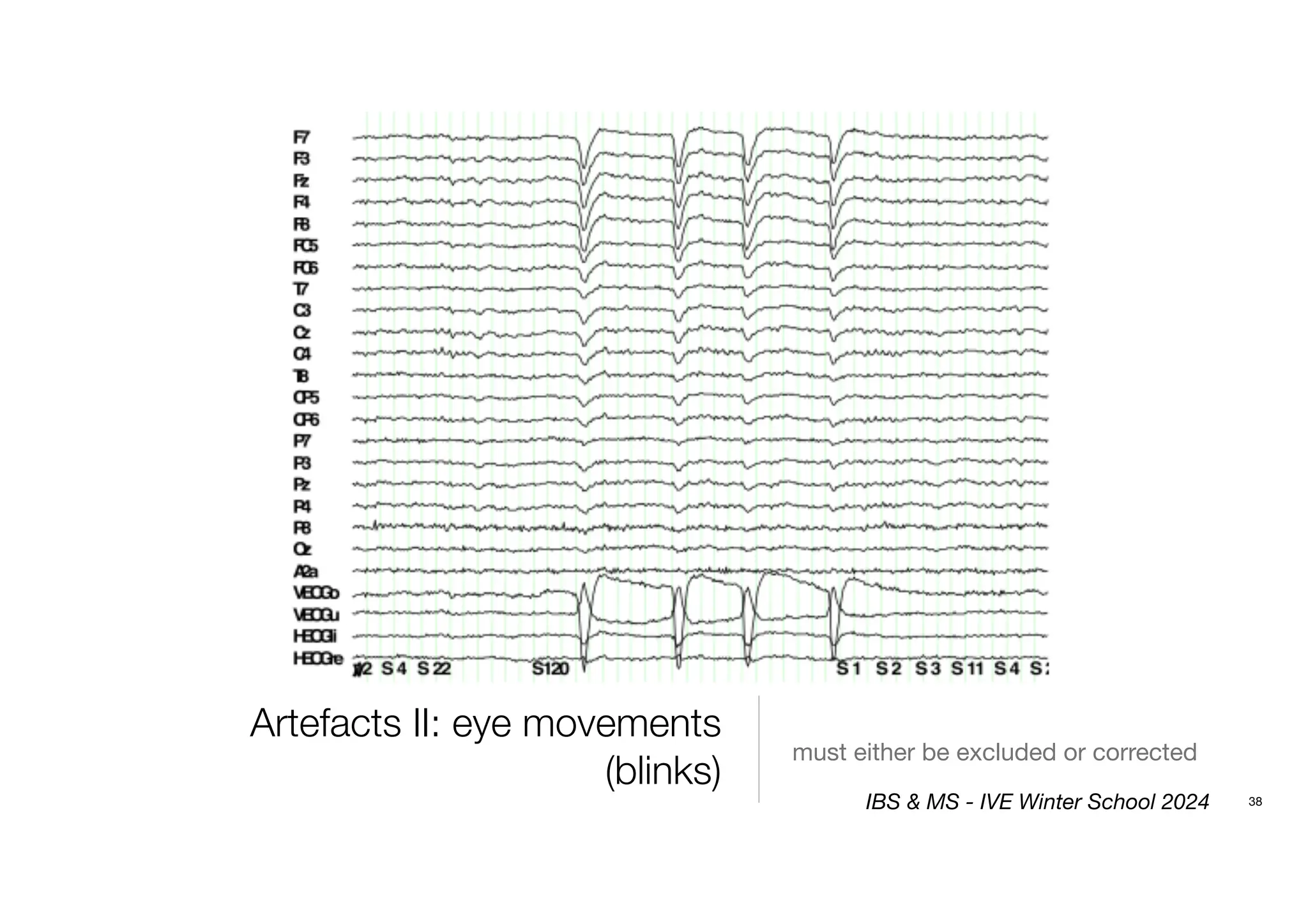 Artefacts II: eye movements
(blinks)
must either be excluded or corrected
38
IBS & MS - IVE Winter School 2024
 