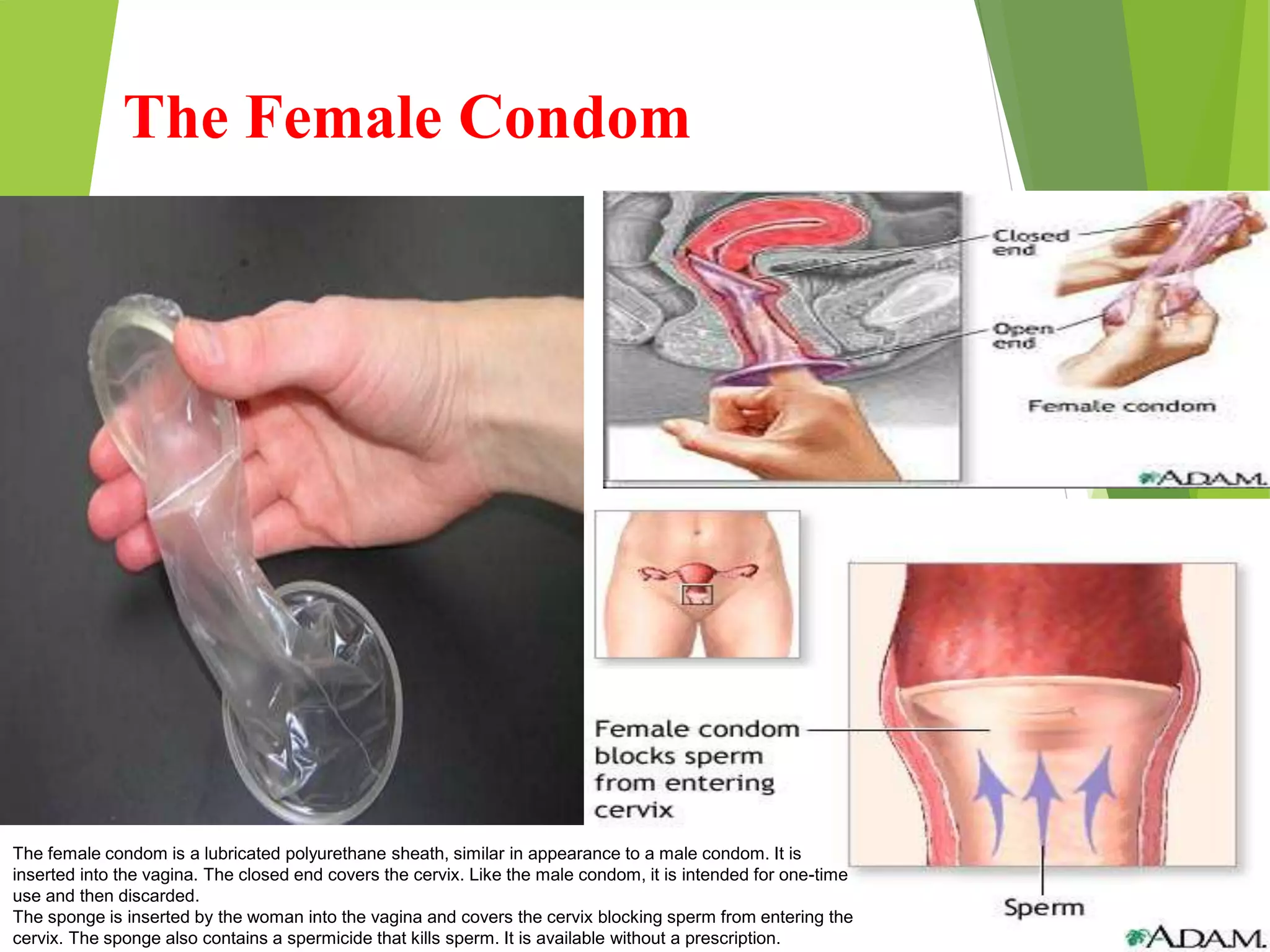 The Female Condom
The female condom is a lubricated polyurethane sheath, similar in appearance to a male condom. It is
inserted into the vagina. The closed end covers the cervix. Like the male condom, it is intended for one-time
use and then discarded.
The sponge is inserted by the woman into the vagina and covers the cervix blocking sperm from entering the
cervix. The sponge also contains a spermicide that kills sperm. It is available without a prescription.
 