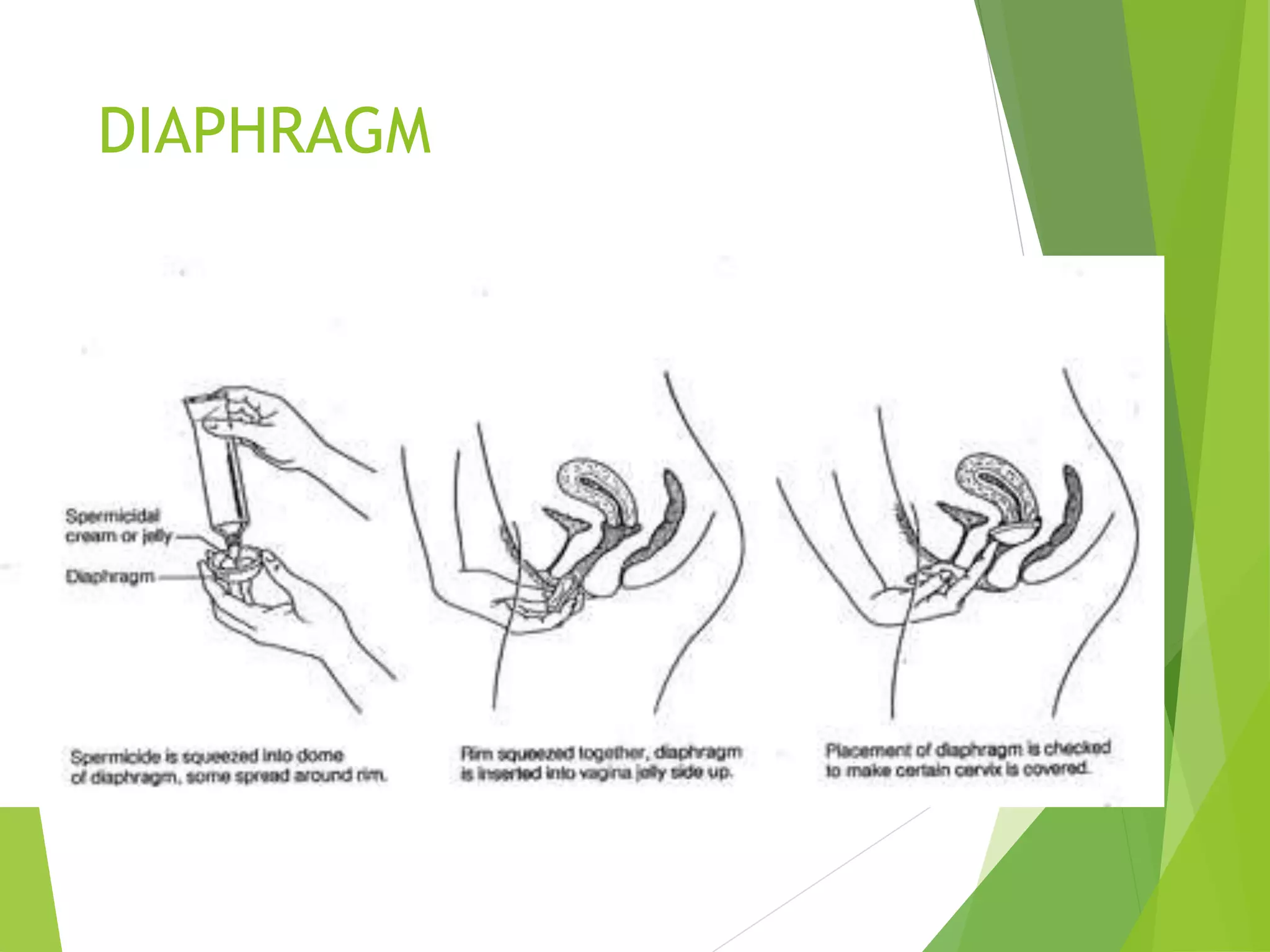 DIAPHRAGM
 