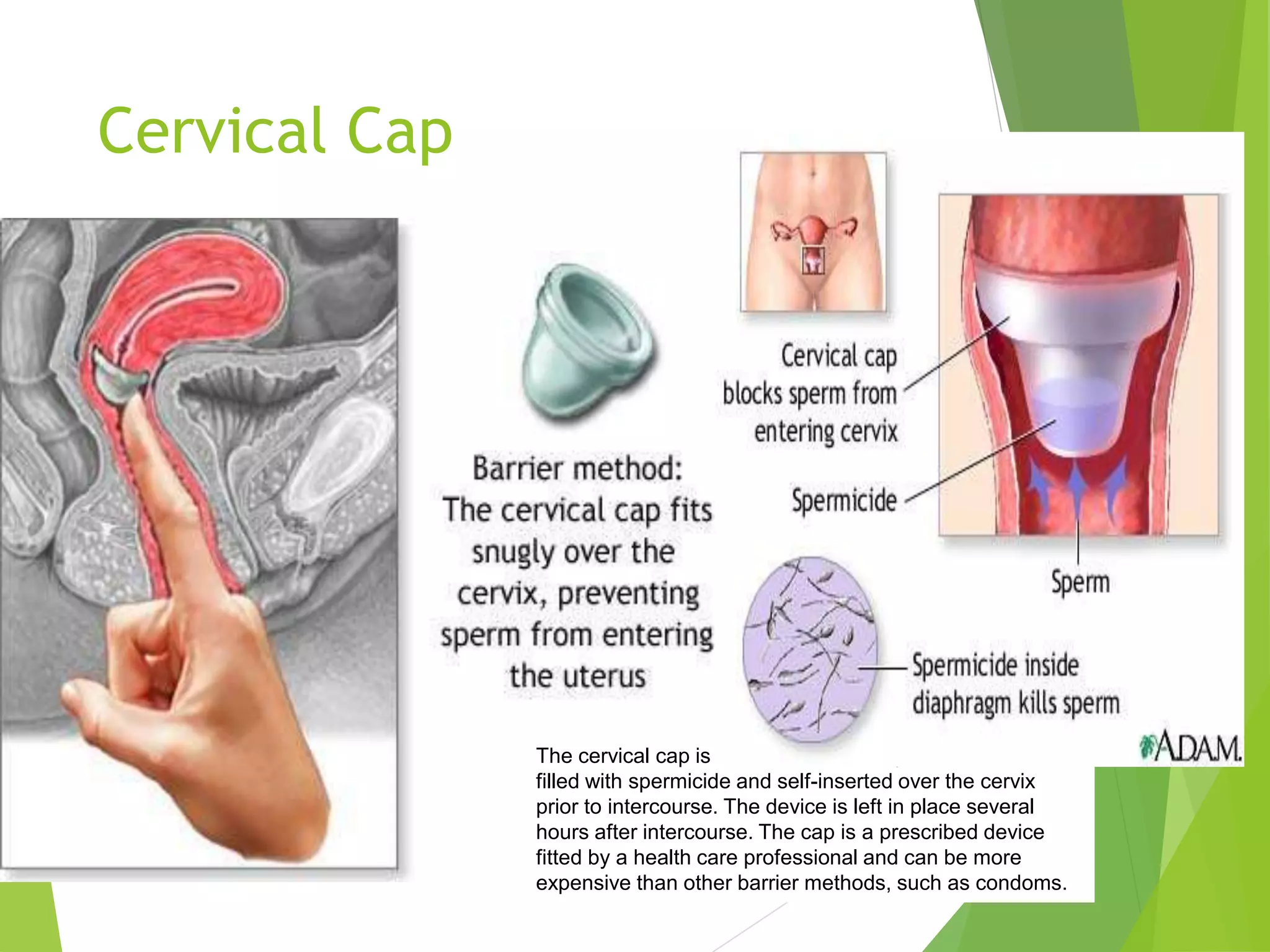 Cervical Cap
The cervical cap is a flexible rubber cup-like device that is
filled with spermicide and self-inserted over the cervix
prior to intercourse. The device is left in place several
hours after intercourse. The cap is a prescribed device
fitted by a health care professional and can be more
expensive than other barrier methods, such as condoms.
 