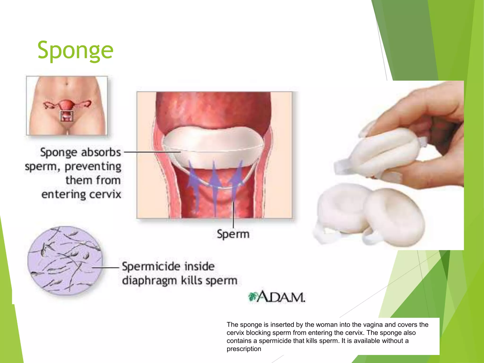 Sponge
The sponge is inserted by the woman into the vagina and covers the
cervix blocking sperm from entering the cervix. The sponge also
contains a spermicide that kills sperm. It is available without a
prescription
 