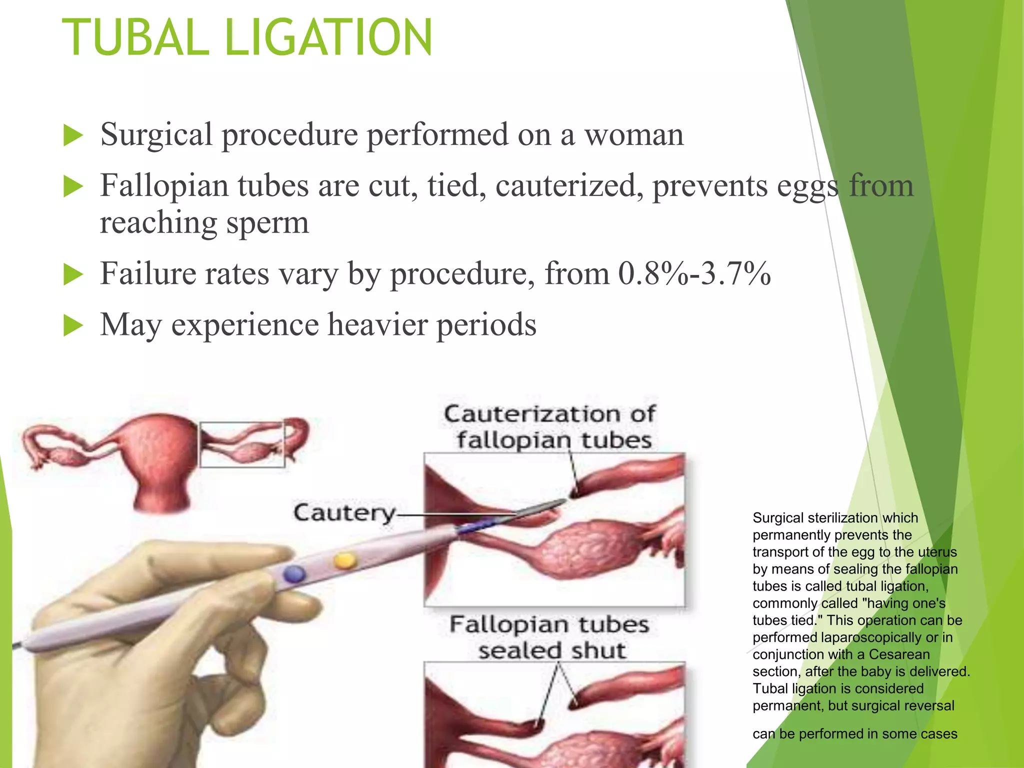 TUBAL LIGATION
 Surgical procedure performed on a woman
 Fallopian tubes are cut, tied, cauterized, prevents eggs from
reaching sperm
 Failure rates vary by procedure, from 0.8%-3.7%
 May experience heavier periods
Surgical sterilization which
permanently prevents the
transport of the egg to the uterus
by means of sealing the fallopian
tubes is called tubal ligation,
commonly called "having one's
tubes tied." This operation can be
performed laparoscopically or in
conjunction with a Cesarean
section, after the baby is delivered.
Tubal ligation is considered
permanent, but surgical reversal
can be performed in some cases
 