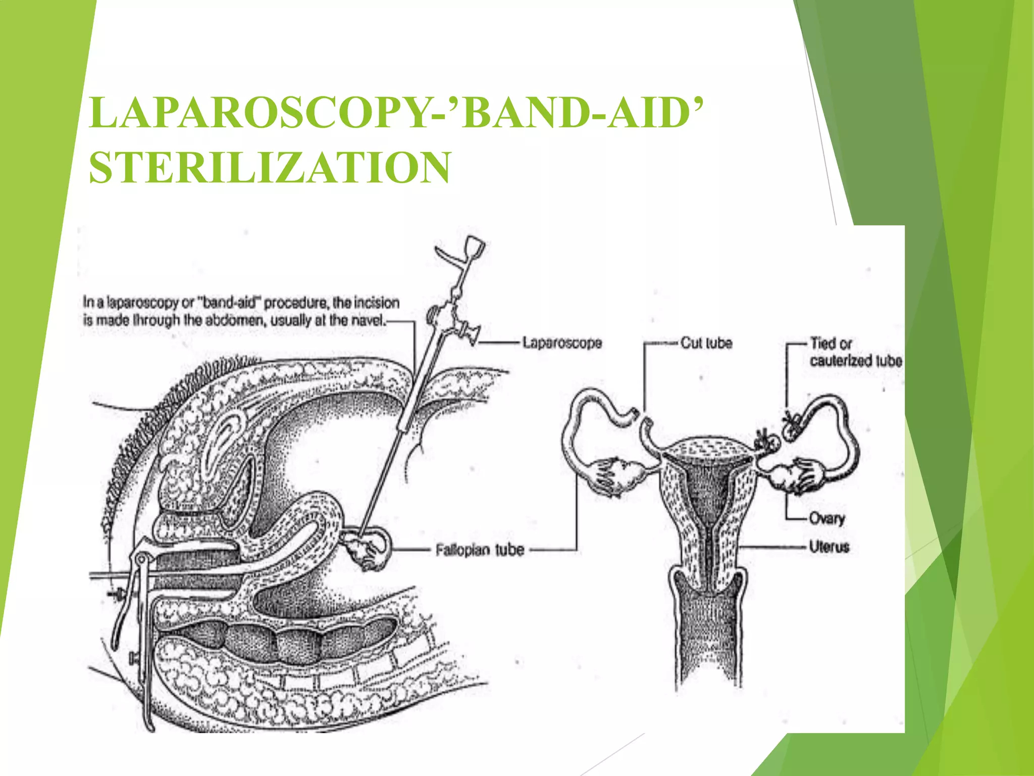 LAPAROSCOPY-’BAND-AID’
STERILIZATION
 