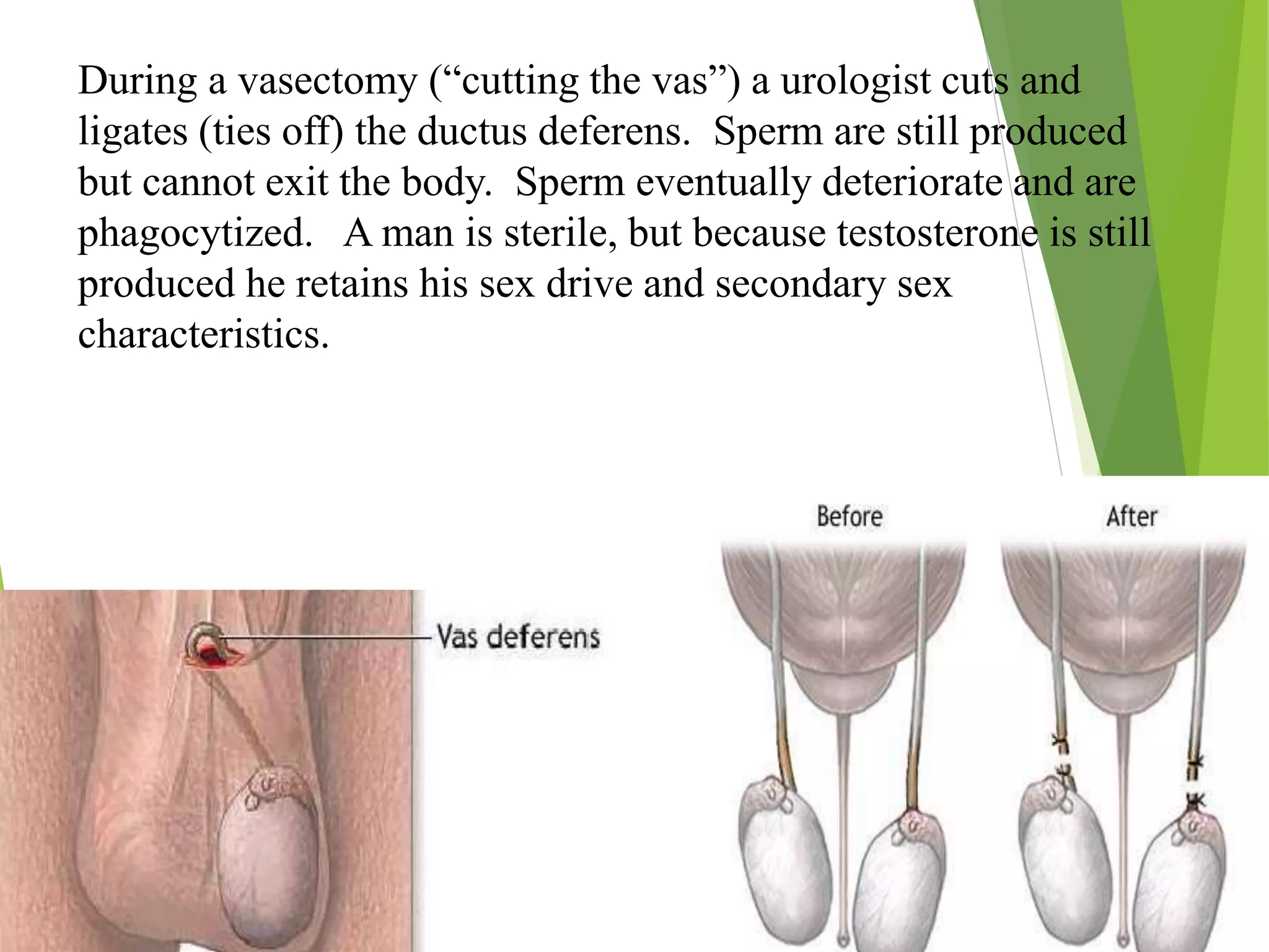 During a vasectomy (“cutting the vas”) a urologist cuts and
ligates (ties off) the ductus deferens. Sperm are still produced
but cannot exit the body. Sperm eventually deteriorate and are
phagocytized. A man is sterile, but because testosterone is still
produced he retains his sex drive and secondary sex
characteristics.
 