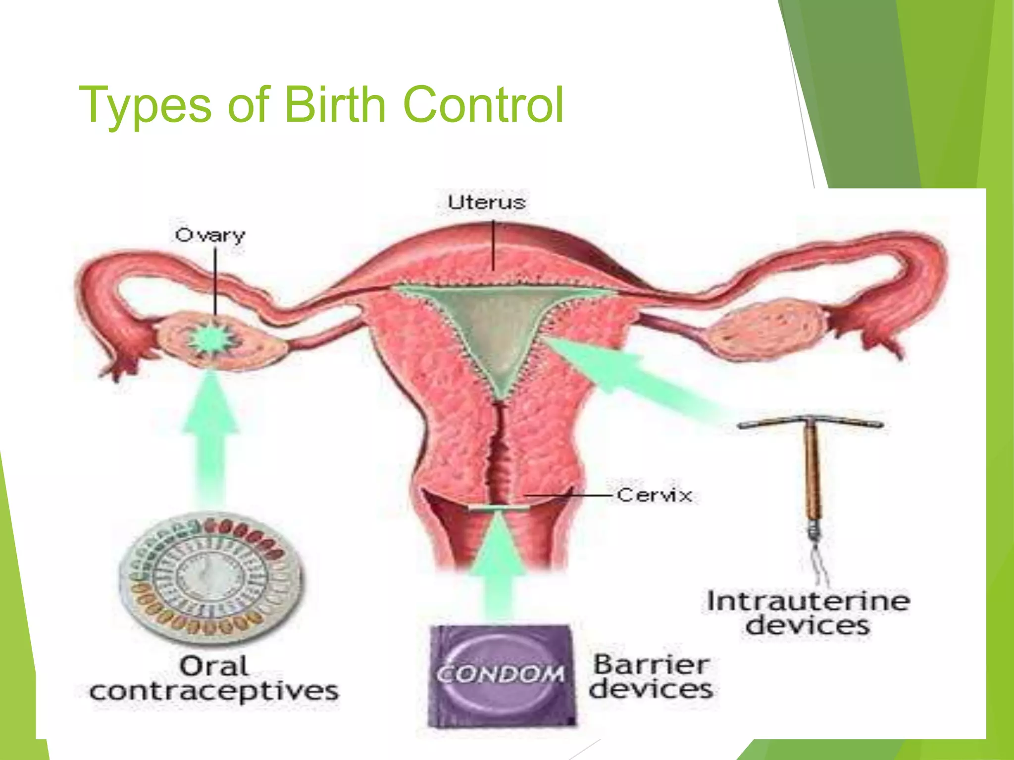 Types of Birth Control
 