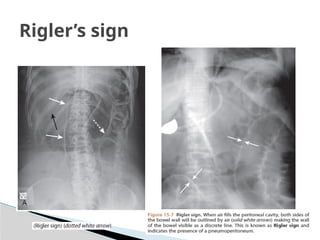 lecture 8 The ACUTE ABDOMEN FGDYYDYDYYXXRTYR | PPTX
