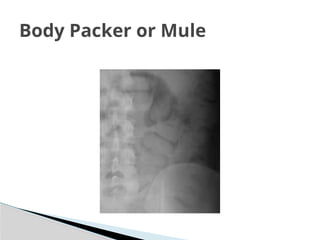 lecture 8 The ACUTE ABDOMEN FGDYYDYDYYXXRTYR | PPTX