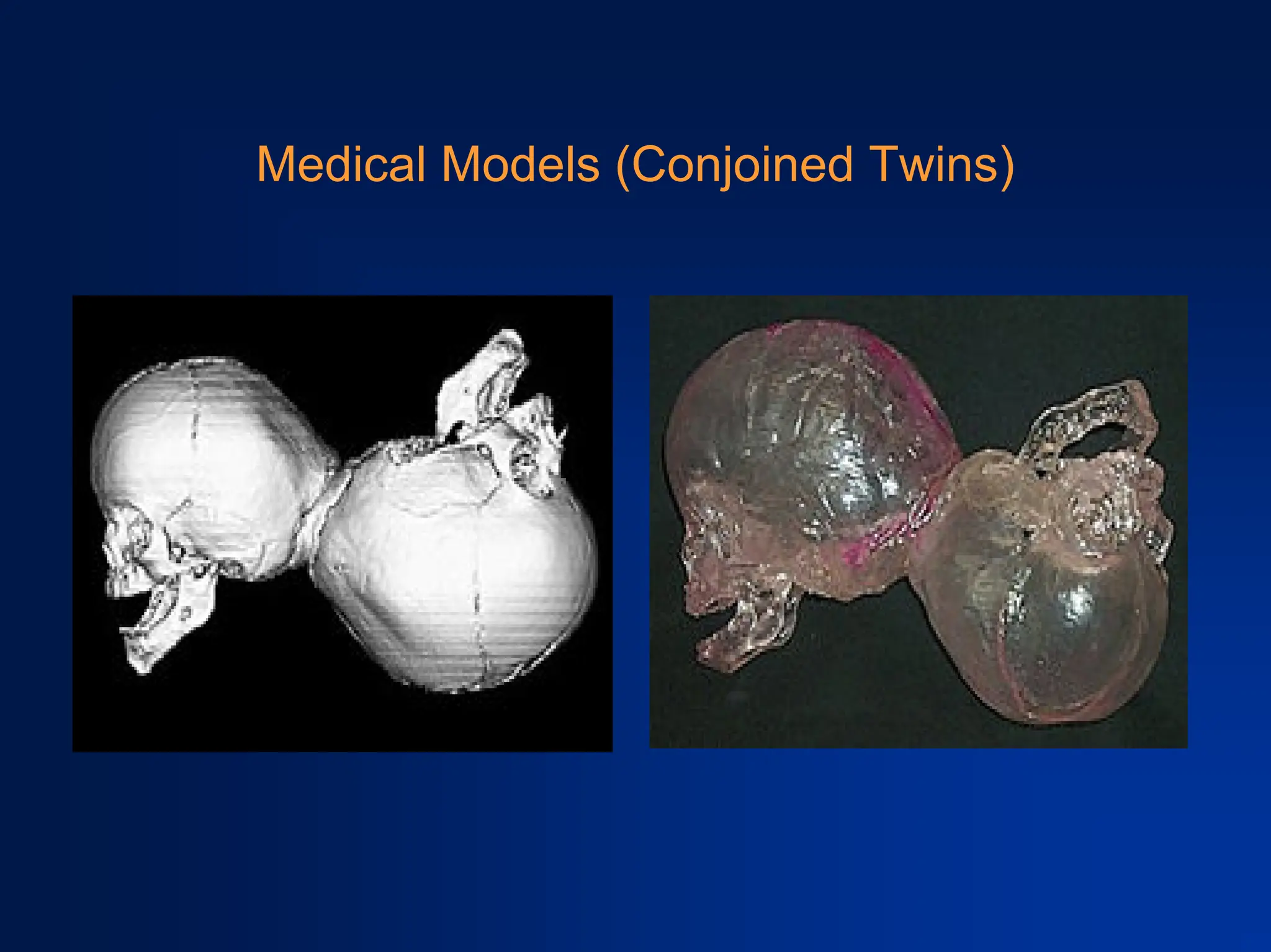 Medical Models (Conjoined Twins)
 