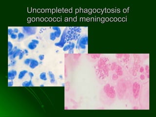 Uncompleted phagocytosis of gonococci and meningococci   