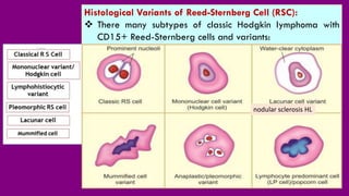 Hodgkin Lymphoma H L pdf hodgkin-lymphoma-h-l-pdf