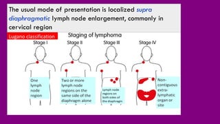 Hodgkin Lymphoma- H.L.pdf