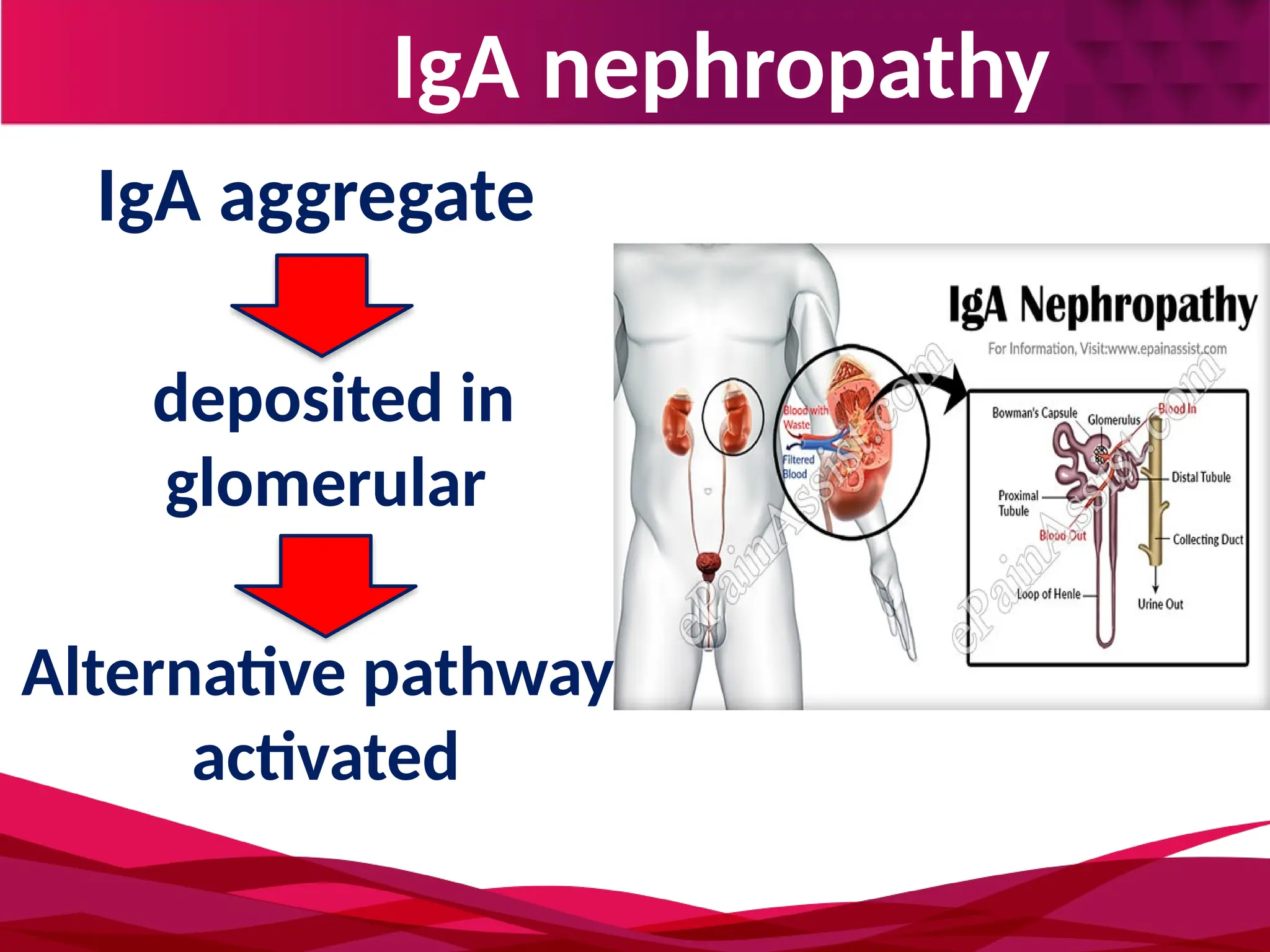 IgA nephropathy
deposited in
glomerular
IgA aggregate
Alternative pathway
activated
 
