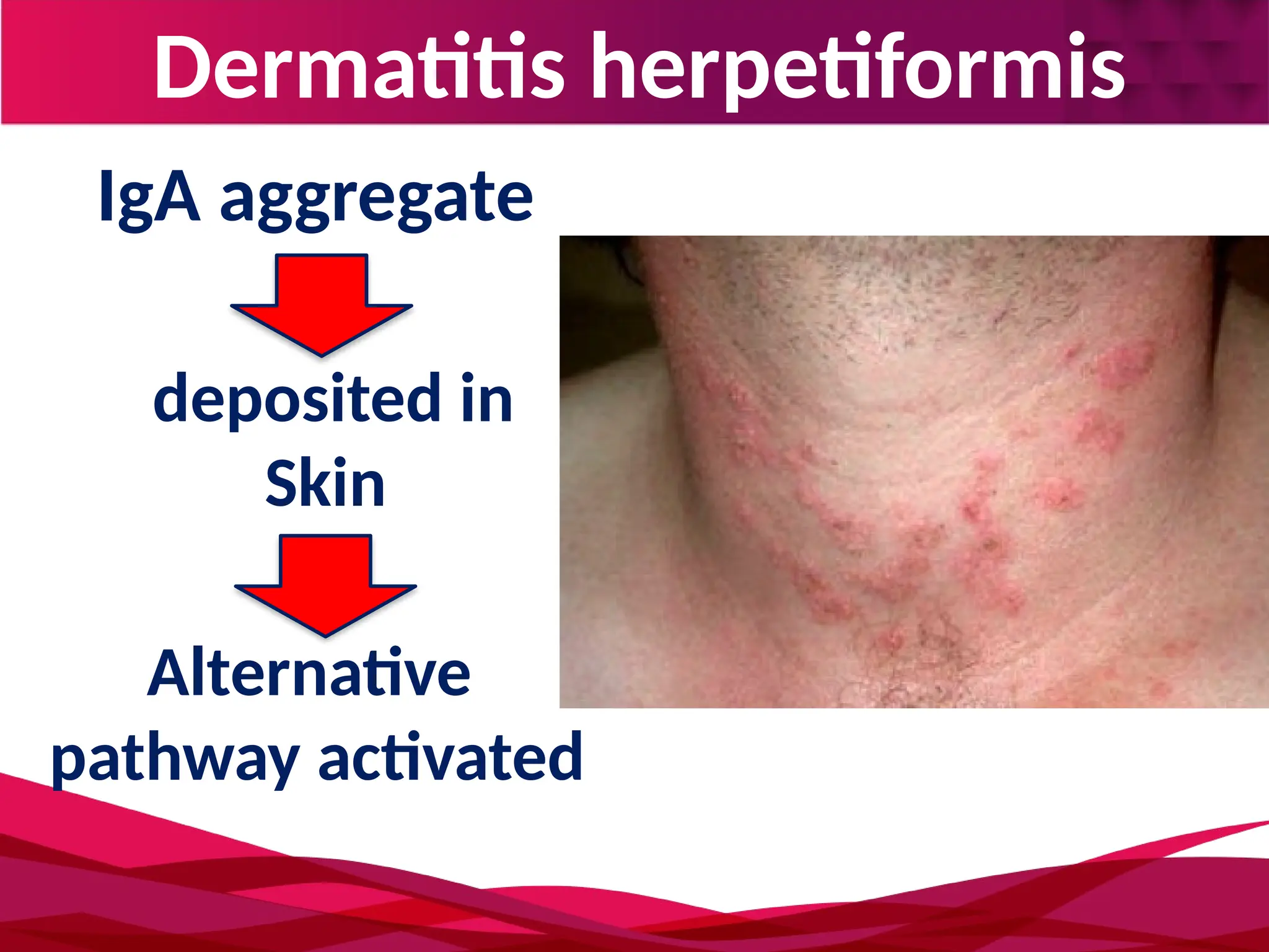 Dermatitis herpetiformis
deposited in
Skin
IgA aggregate
Alternative
pathway activated
 