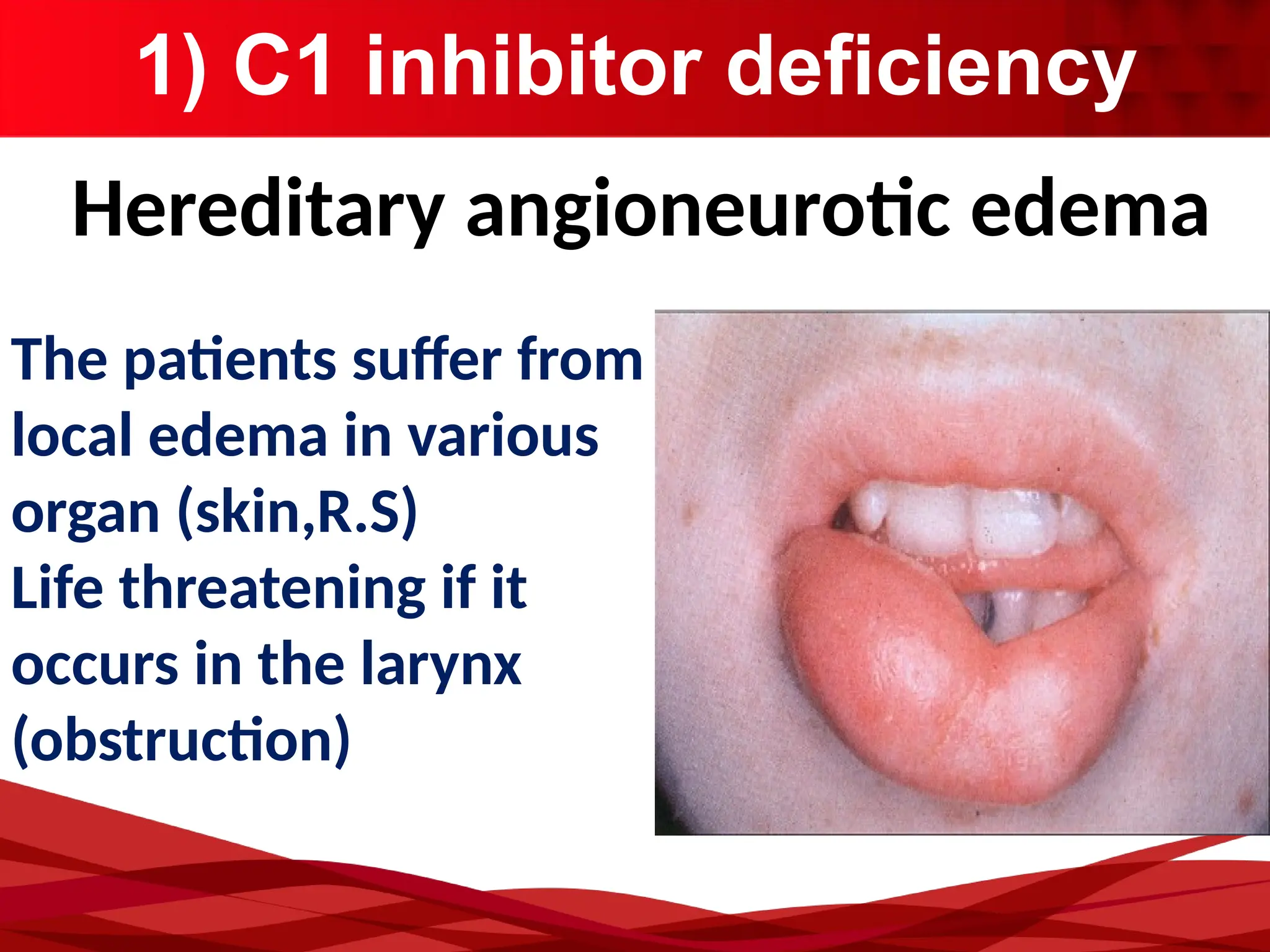 1) C1 inhibitor deficiency
Hereditary angioneurotic edema
The patients suffer from
local edema in various
organ (skin,R.S)
Life threatening if it
occurs in the larynx
(obstruction)
 