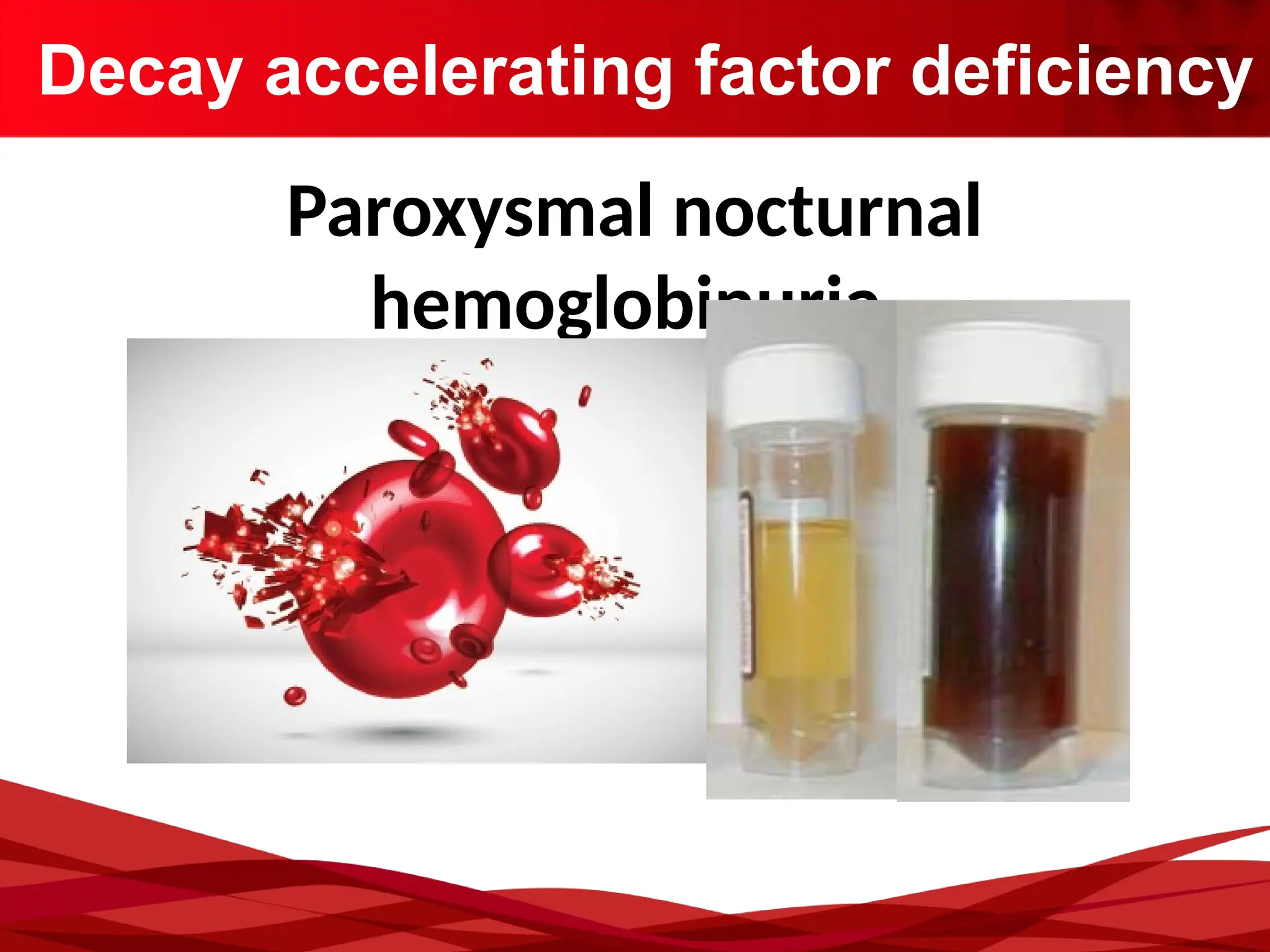Decay accelerating factor deficiency
Paroxysmal nocturnal
hemoglobinuria
 
