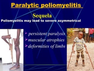 Sequela
Poliomyelitis may lead to severe asymmetrical
 persistent paralysis
muscular atrophies
deformities of limbs
Paralytic poliomyelitis
 
