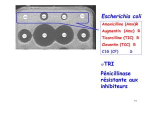 AMX AMC TIC
TCC
CAZ
CF TZP
CTX
Escherichia coli
Amoxicilline (Amx)R
Augmentin (Amc) R
Ticarcilline (TIC) R
Claventin (TCC) R
C1G (CF) S
TRI
Pénicillinase
résistante aux
inhibiteurs
77
 