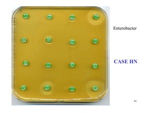 Enterobacter
AMX TIC PIP Mec
CTX
AMC
TZP MA
TCC
CT
CAZ FOX
IP
MOX
FEP
AZT
CASE HN
81
 