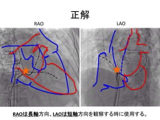 Lao Rao Rai Scan How to puncture the atrial septum (lectures for residents) | PPTX