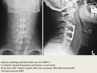 BMP bone morphogenic protein in spinal surgery | PPTX