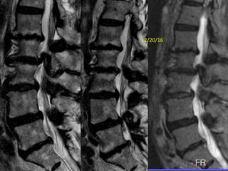 BMP bone morphogenic protein in spinal surgery | PPTX