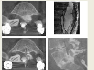 BMP bone morphogenic protein in spinal surgery | PPTX