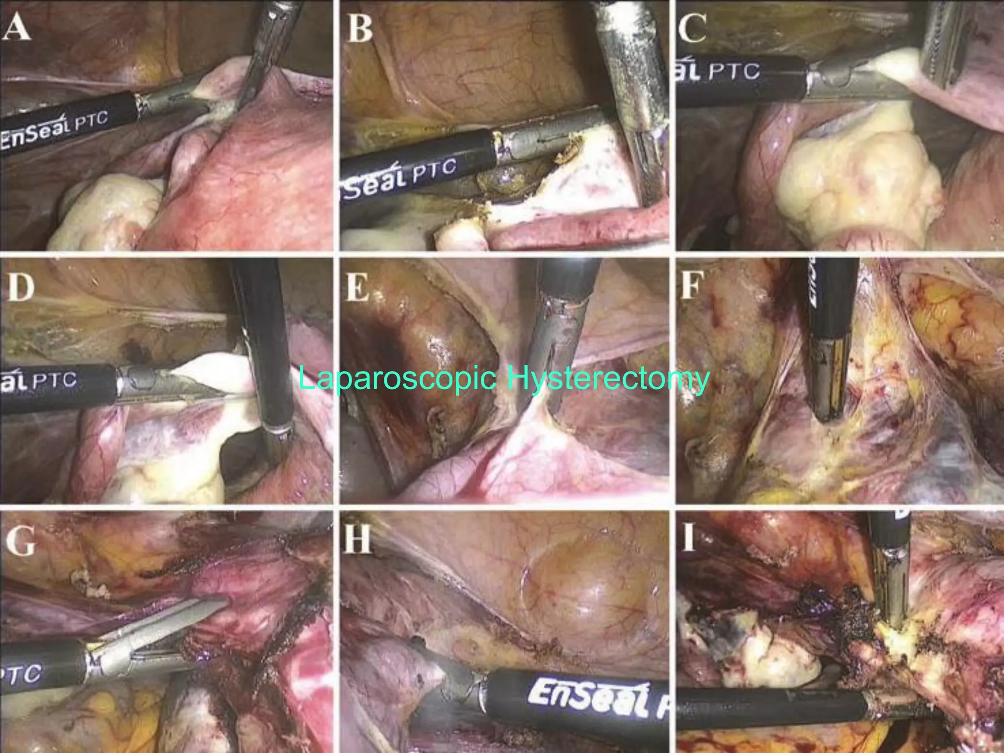Laparoscopic Hysterectomy
 