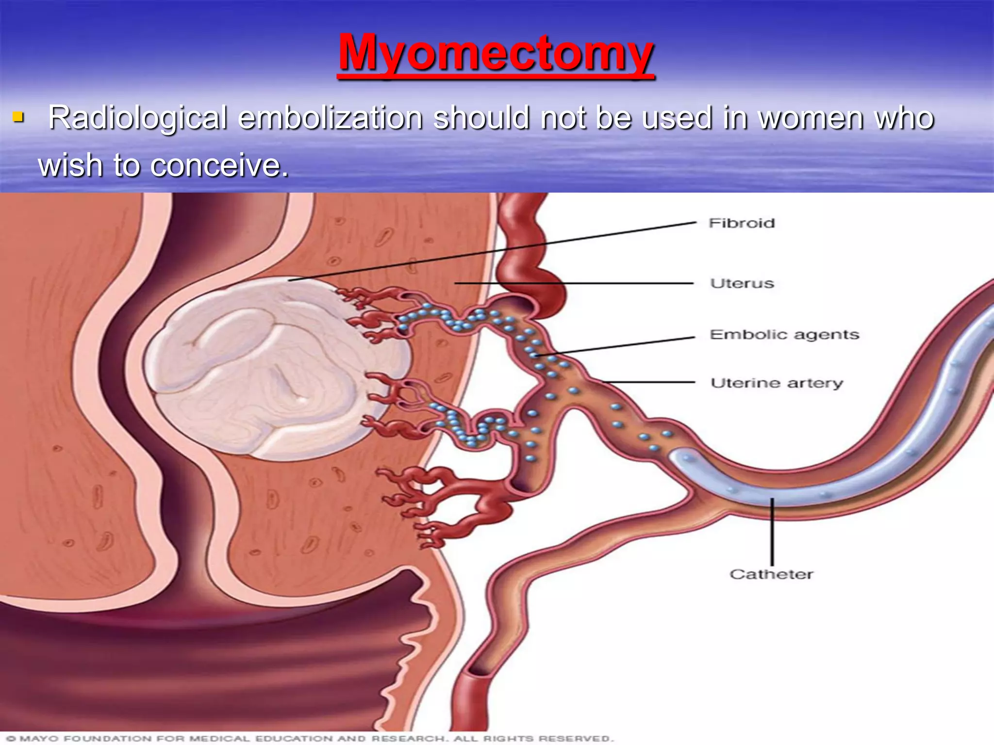 Myomectomy
 Radiological embolization should not be used in women who
wish to conceive.
 