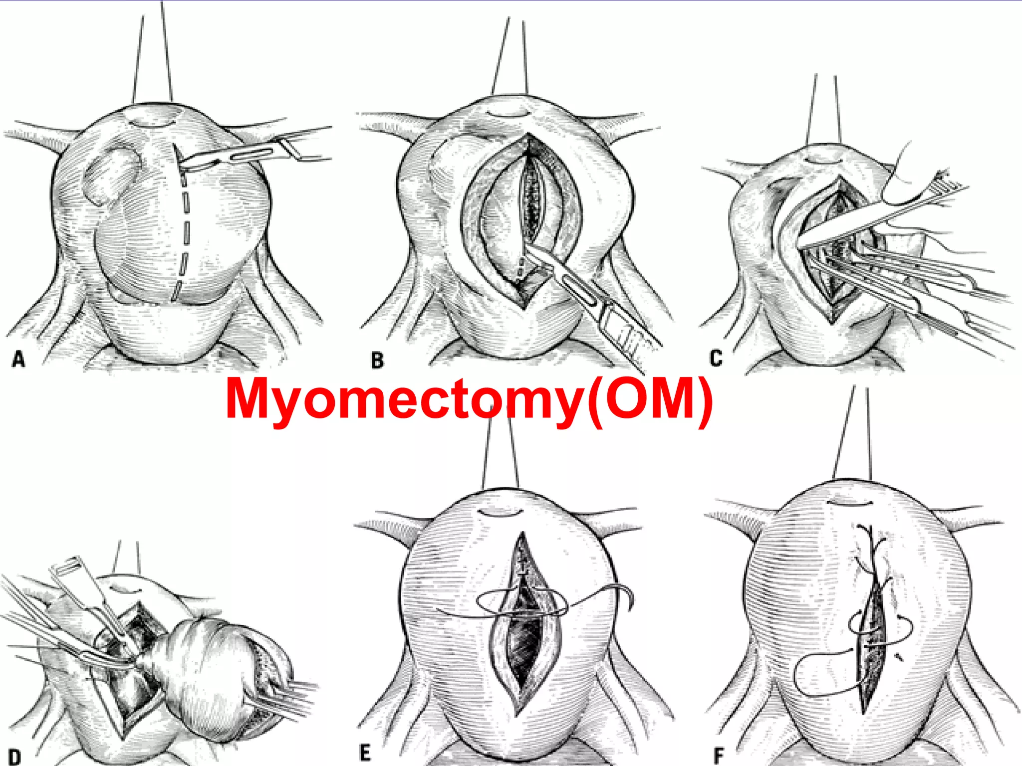 Myomectomy(OM)
 