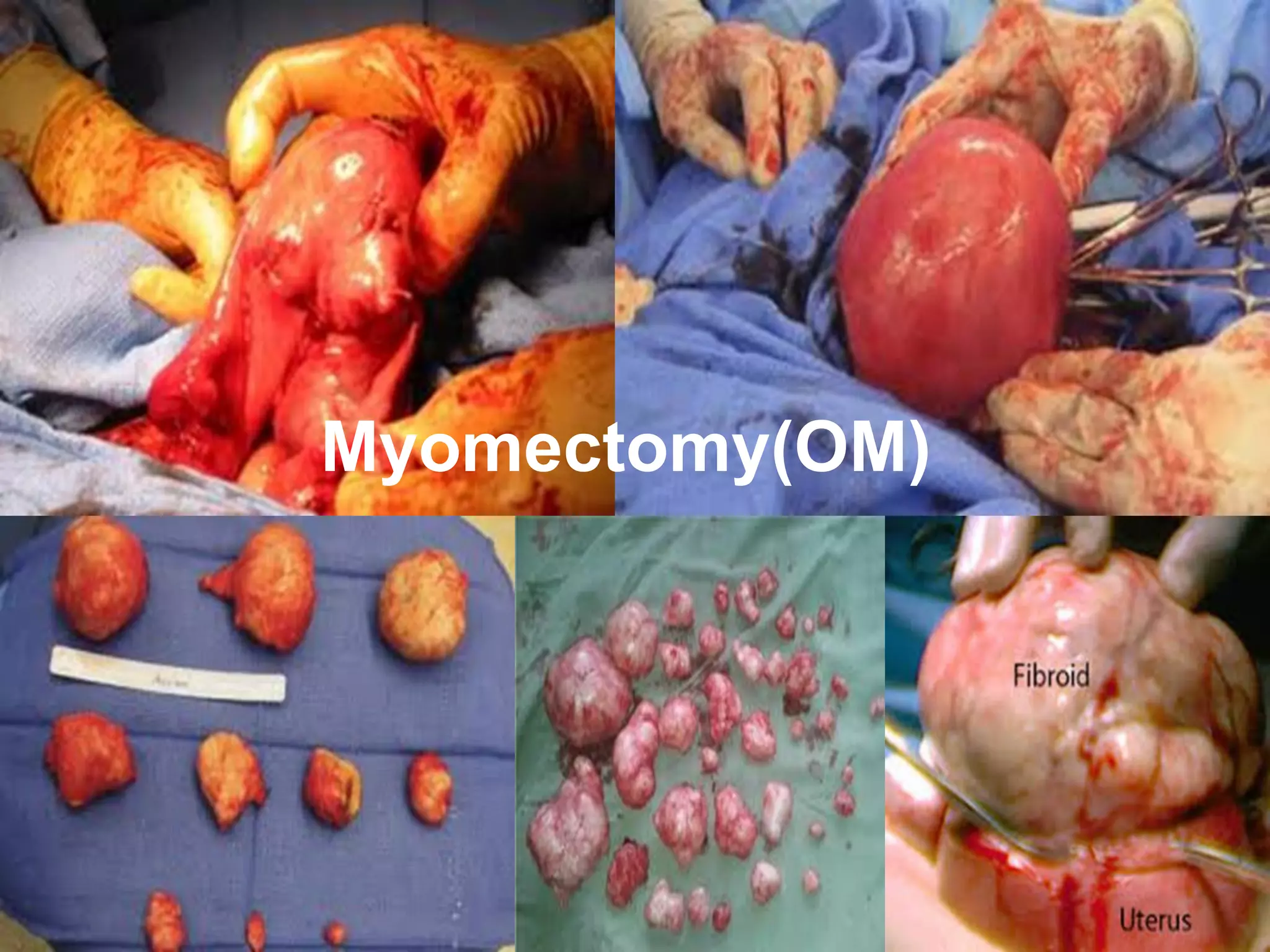 Myomectomy(OM)
 