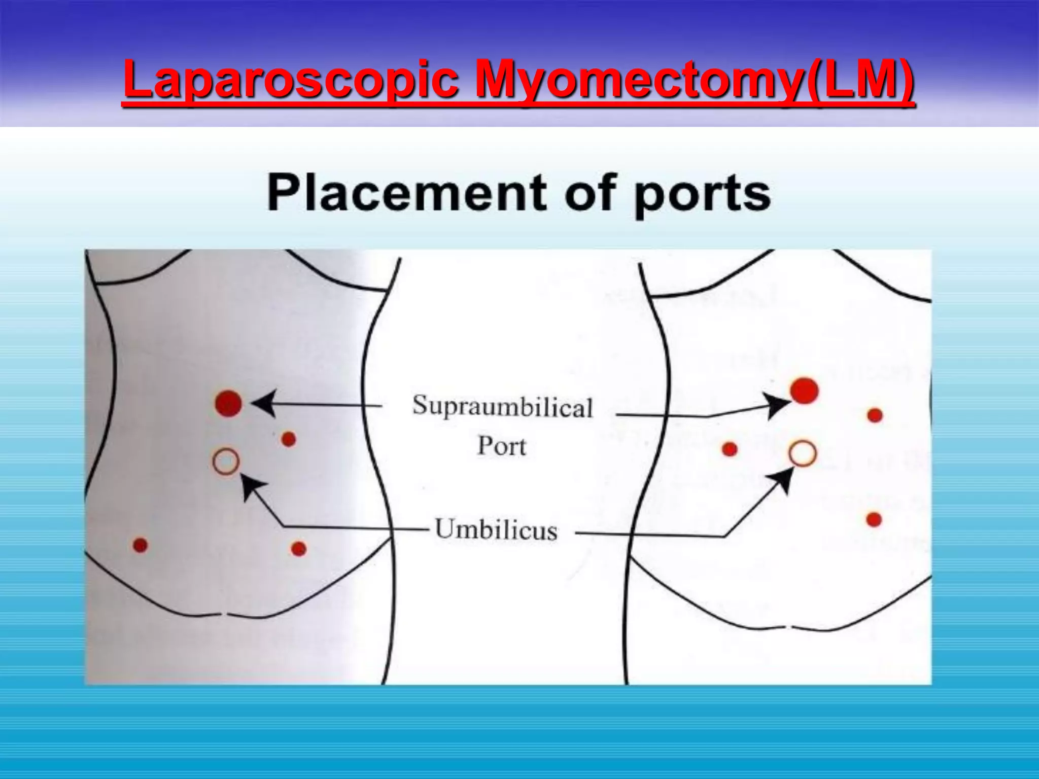Laparoscopic Myomectomy(LM)
 