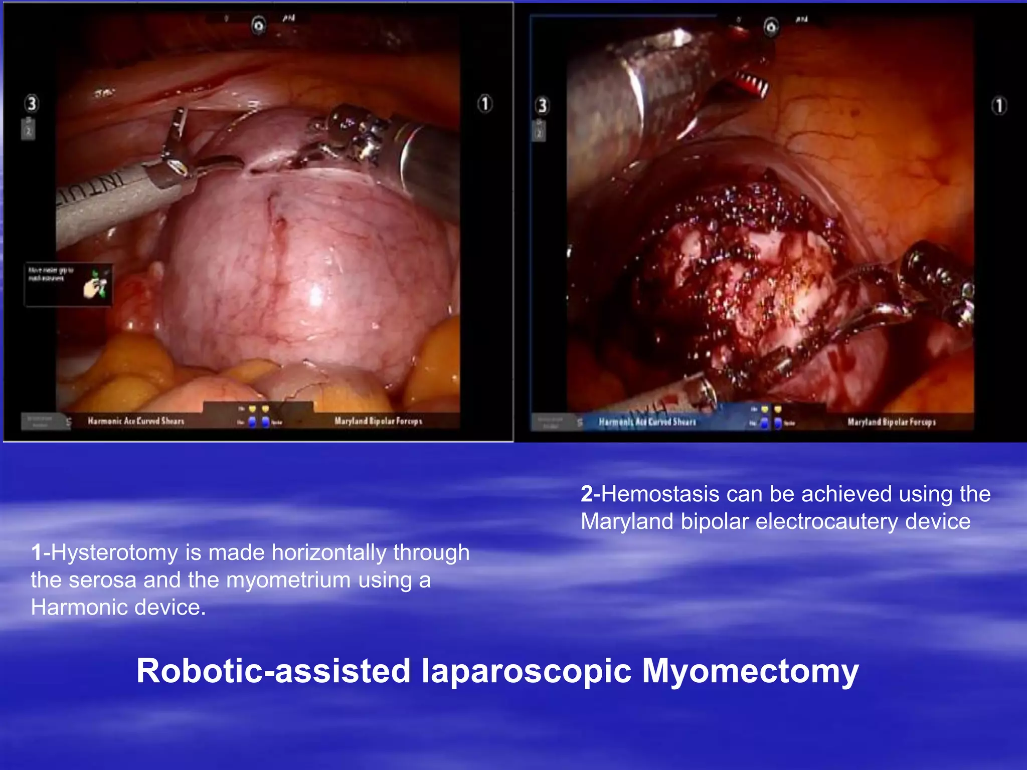 1-Hysterotomy is made horizontally through
the serosa and the myometrium using a
Harmonic device.
2-Hemostasis can be achieved using the
Maryland bipolar electrocautery device
Robotic-assisted laparoscopic Myomectomy
 