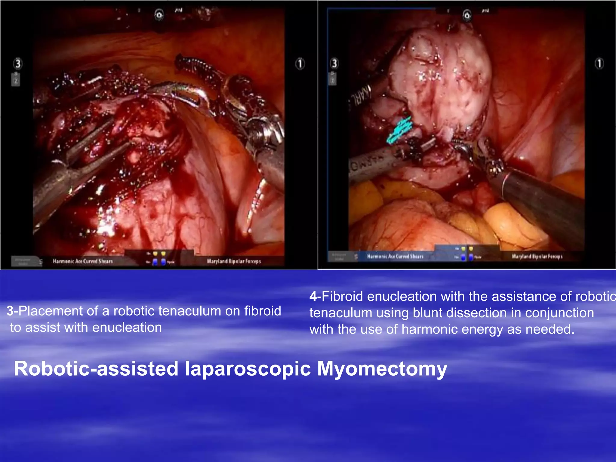 3-Placement of a robotic tenaculum on fibroid
to assist with enucleation
4-Fibroid enucleation with the assistance of robotic
tenaculum using blunt dissection in conjunction
with the use of harmonic energy as needed.
Robotic-assisted laparoscopic Myomectomy
 