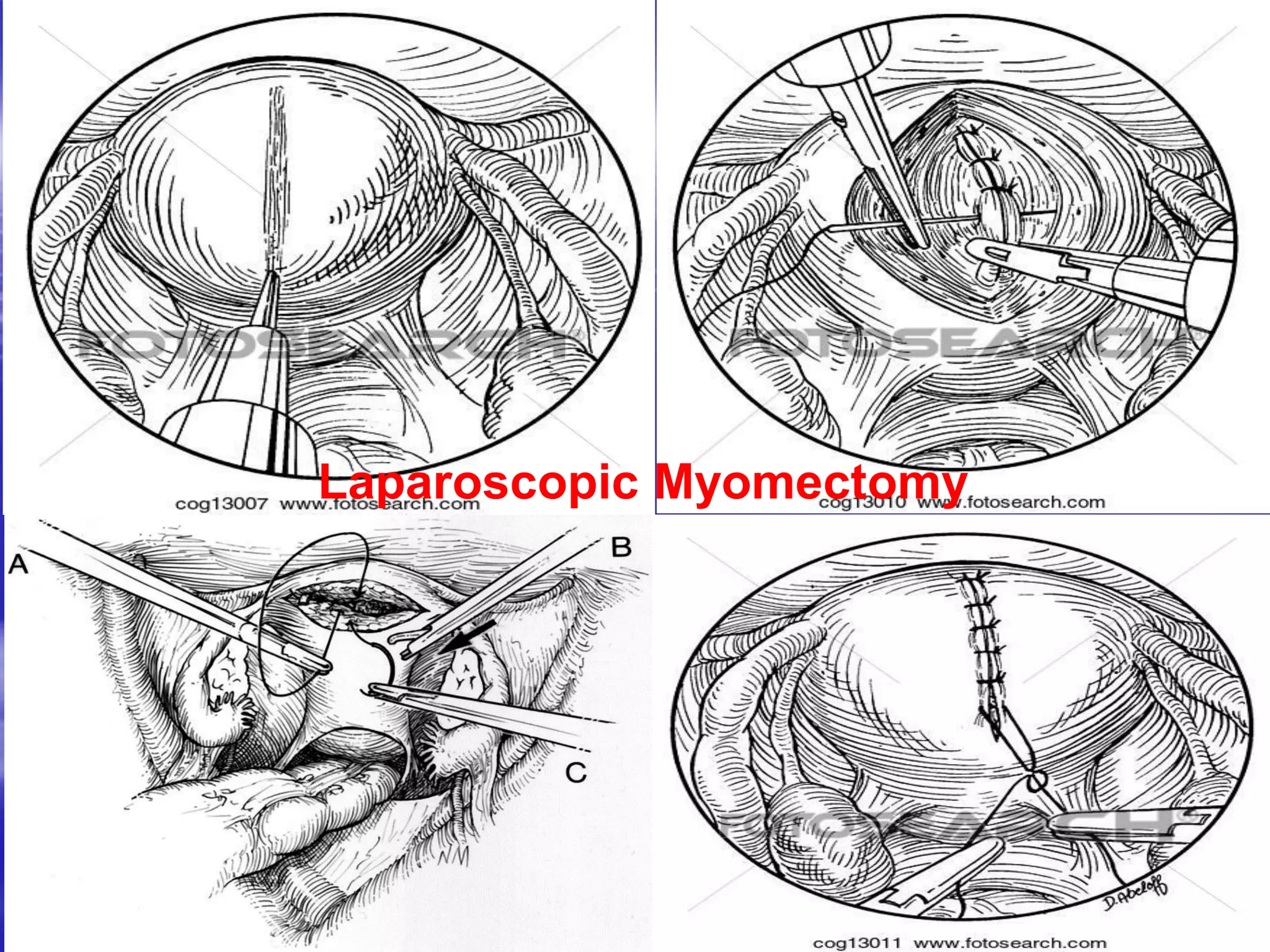 Laparoscopic Myomectomy
 