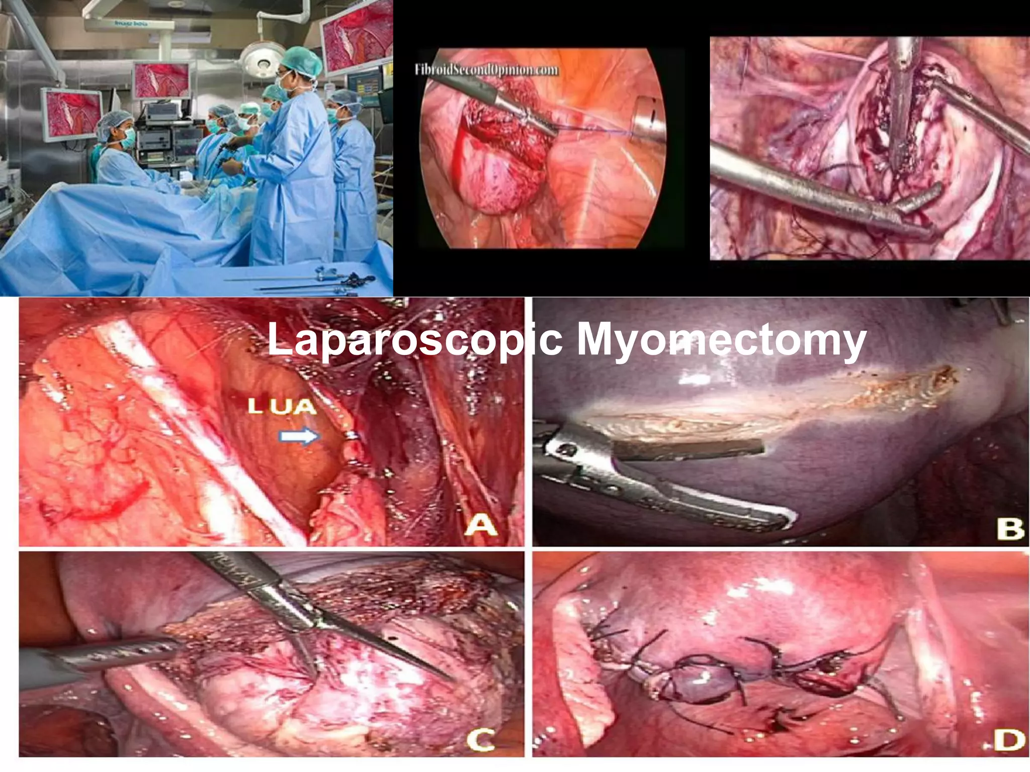 Laparoscopic Myomectomy
 