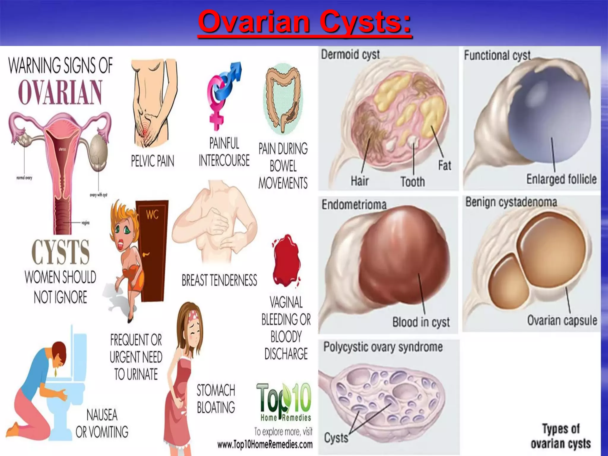 Ovarian Cysts:
 